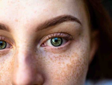 C'est quoi des taches de rousseur ?