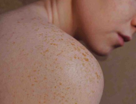 Comment rajeunir la peau qui vieillit ?