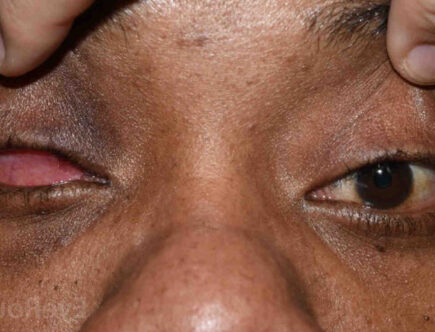 Comment se brider les yeux sans chirurgie ?